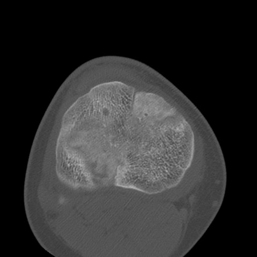 Brodie abscess of the tibia (Radiopaedia 58984-66250 Axial bone window 66).jpg