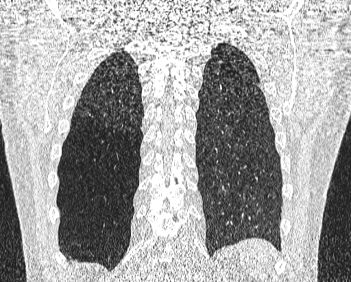 Bronchial atresia (Radiopaedia 58271-65417 Coronal lung window 50).jpg