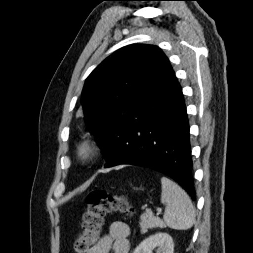 Bronchial carcinoid tumor (Radiopaedia 67377-76764 E 55).jpg