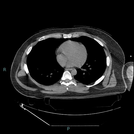 Bronchial carcinoid tumor (Radiopaedia 78272-90870 Axial non-contrast 65).jpg