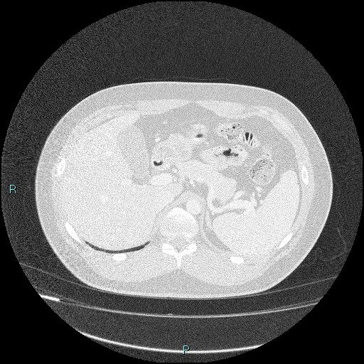 Bronchial carcinoid tumor (Radiopaedia 78272-90875 Axial lung window 56).jpg
