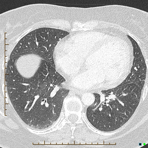 File:Bronchial diverticula (Radiopaedia 79512-92676 Axial lung window 129).jpg
