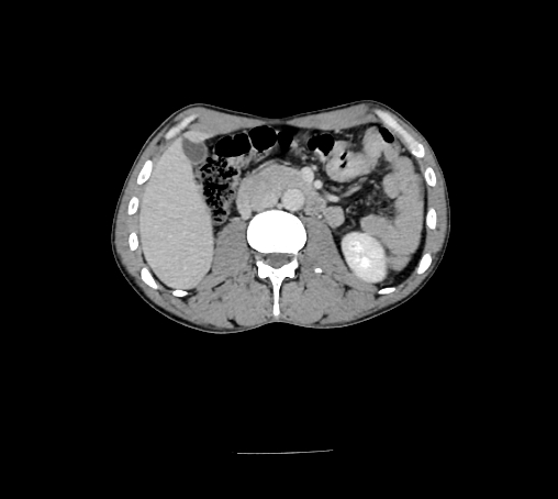 Bronchiectasis in Crohn disease (Radiopaedia 60311-67977 B 75).jpg