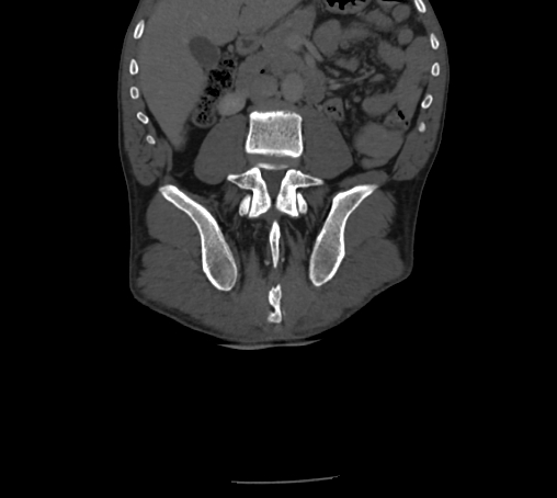 Bronchiectasis in Crohn disease (Radiopaedia 60311-67977 Coronal bone window 55).jpg