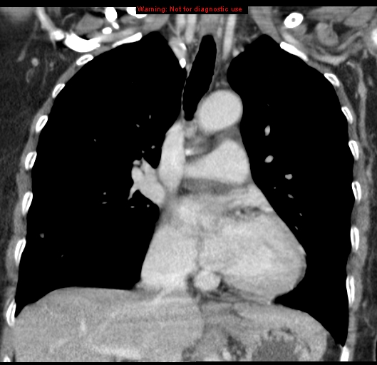 Bronchoalveolar carcinoma (BAC) (Radiopaedia 13436-13392 E 26).jpg
