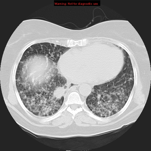 Bronchoalveolar carcinoma (Radiopaedia 13224-13233 Axial lung window 30).jpg