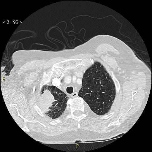 File:Bronchogenic carcinoma as an incidental finding (Radiopaedia 16453-16130 Axial lung window 99).jpg
