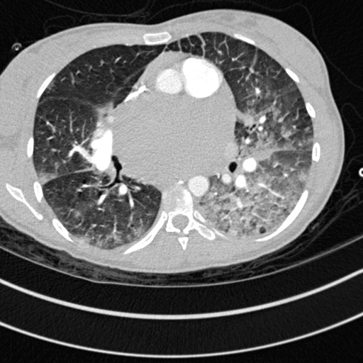Bronchogenic cyst (Radiopaedia 77801-90071 Axial lung window 36).jpg