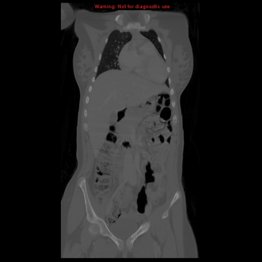File:Brown tumor (Radiopaedia 12318-12596 D 25).jpg