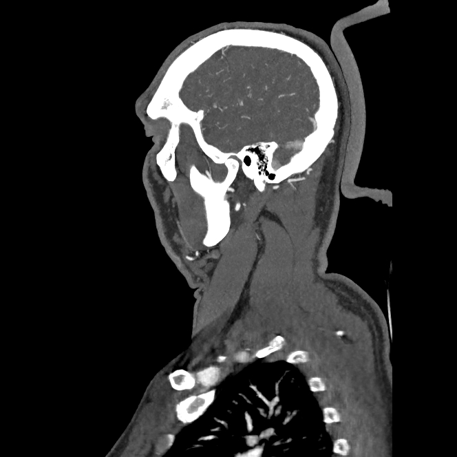 Buccal fat pad arteriovenous malformation (Radiopaedia 70936-81144 C 62).jpg