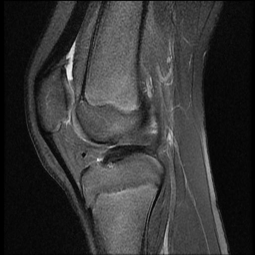File:Bucket handle tear - lateral meniscus (Radiopaedia 72124-82634 Sagittal PD fat sat 7).jpg