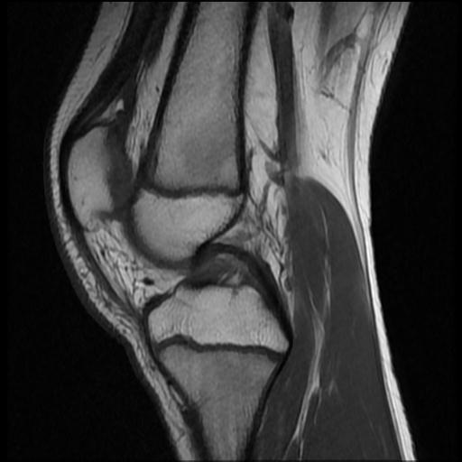 File:Bucket handle tear - lateral meniscus (Radiopaedia 72124-82634 Sagittal T1 9).jpg