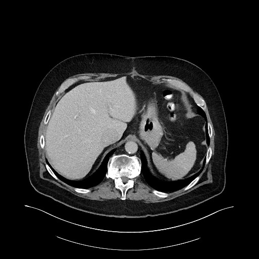 Buried bumper syndrome - gastrostomy tube (Radiopaedia 63843-72575 A 6).jpg