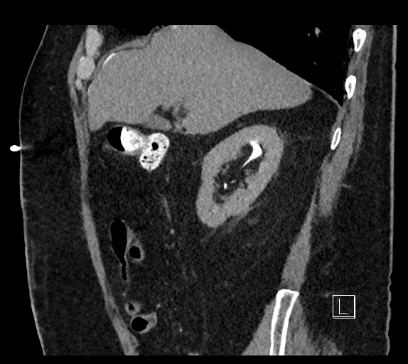 Buried bumper syndrome - gastrostomy tube (Radiopaedia 63843-72577 Sagittal Inject 86).jpg