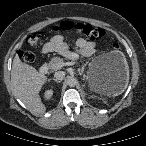 File:Burned-out testicular seminoma - retroperitoneal nodal metastases (Radiopaedia 62872-71245 A 24).jpg