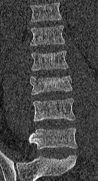 File:Burst fracture (Radiopaedia 53373-59357 Coronal bone window 27).jpg