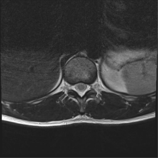 File:Burst fracture - T12 with conus compression (Radiopaedia 56825-63646 Axial T2 24).png