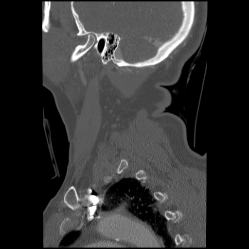 File:C1 anterior arch (plough) fracture - type 1 (Radiopaedia 76181-87720 Sagittal bone window 22).jpg