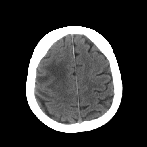 File:CNS lymphoma (Radiopaedia 36983-38639 Axial non-contrast 29).png