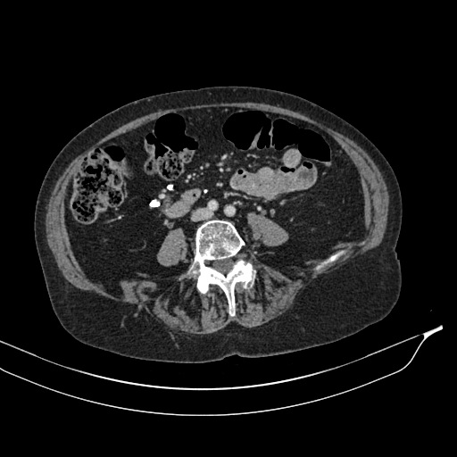 Calcified adrenal glands and Spigelian hernia (Radiopaedia 49741-54988 A 133).jpg