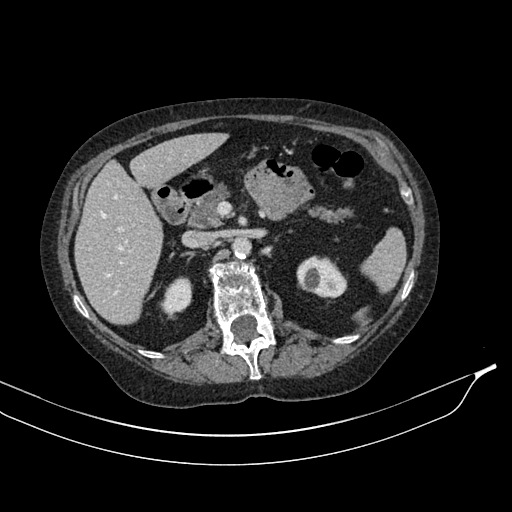 Calcified adrenal glands and Spigelian hernia (Radiopaedia 49741-54988 A 70).jpg