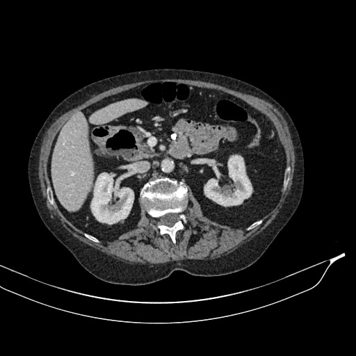 Calcified adrenal glands and Spigelian hernia (Radiopaedia 49741-54988 A 81).jpg