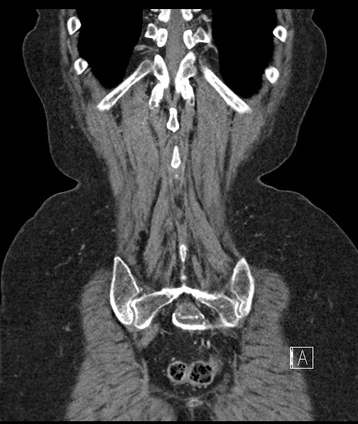 Calcified adrenal glands and Spigelian hernia (Radiopaedia 49741-54988 B 104).jpg