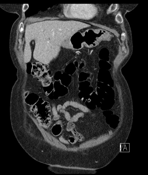 Calcified adrenal glands and Spigelian hernia (Radiopaedia 49741-54988 B 24).jpg