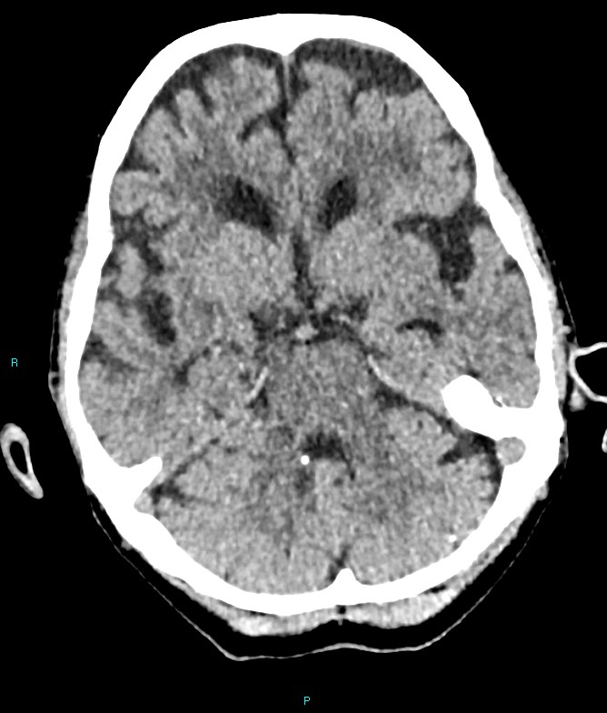 Calcified cerebral emboli from left ventricular thrombus (Radiopaedia 84420-99758 Axial non-contrast 63).jpg