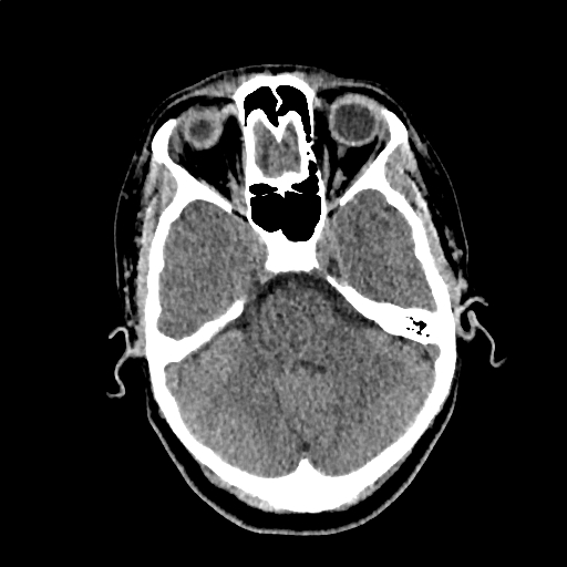 Calcified cerebral hydatid cyst (Radiopaedia 65603-74717 Axial non-contrast 14).jpg