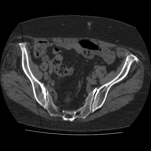 File:Calcified fibroids (Radiopaedia 16853-16579 non-contrast 2).jpg