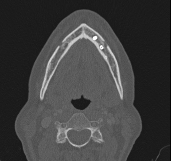 Caldwell-Luc operation (Radiopaedia 52329-58225 Axial bone window 64).jpg