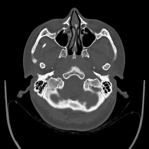 Calvarial osteoma (Radiopaedia 36520-38079 Axial bone window 16).jpg