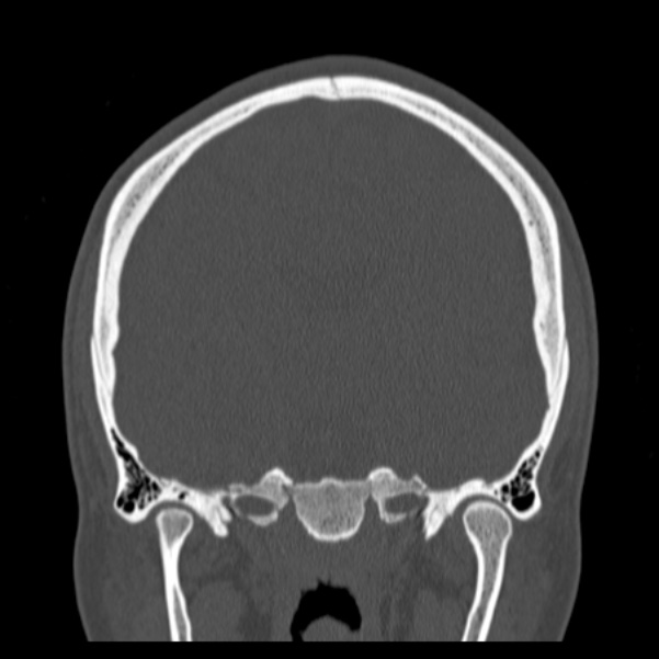 Calvarial osteoma (Radiopaedia 36520-38079 C 48).jpg
