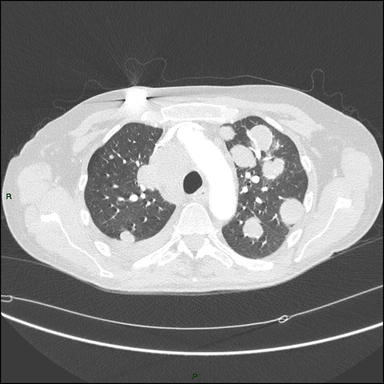 Cannonball metastases (Radiopaedia 82110-96150 Axial lung window 64).jpg