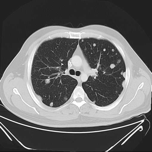 File:Cannonball pulmonary metastases (Radiopaedia 67684-77101 Axial lung window 9).jpg