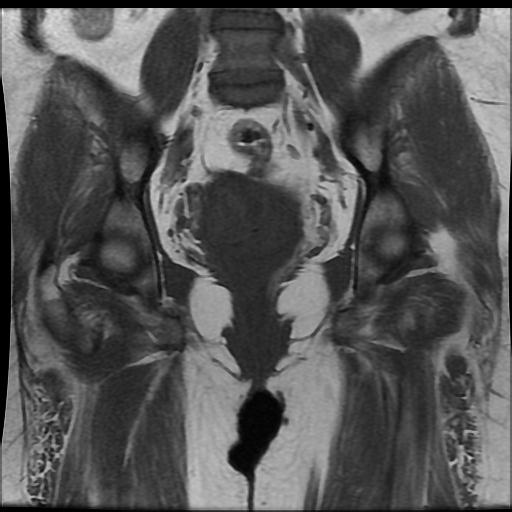 File:Carcinoma of the cervix (Radiopaedia 89018-105858 Coronal T1 10).jpg