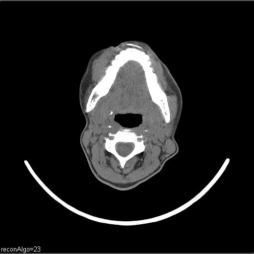Carcinoma of the maxillary antrum (Radiopaedia 53805-59888 Axial non-contrast 41).jpg