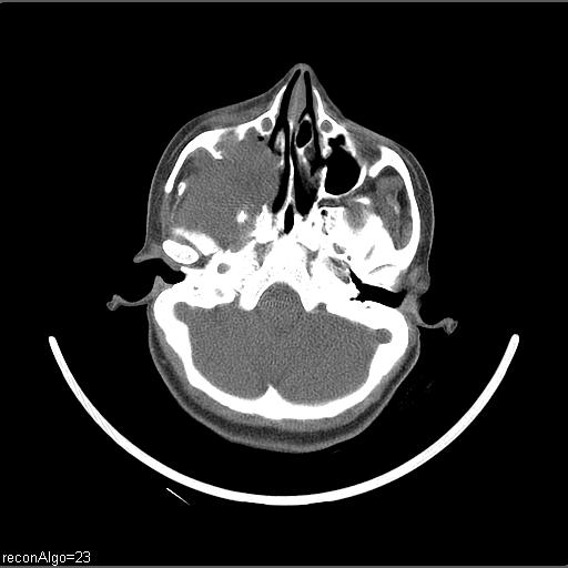 Carcinoma of the maxillary antrum (Radiopaedia 53805-59888 Axial non-contrast 64).jpg