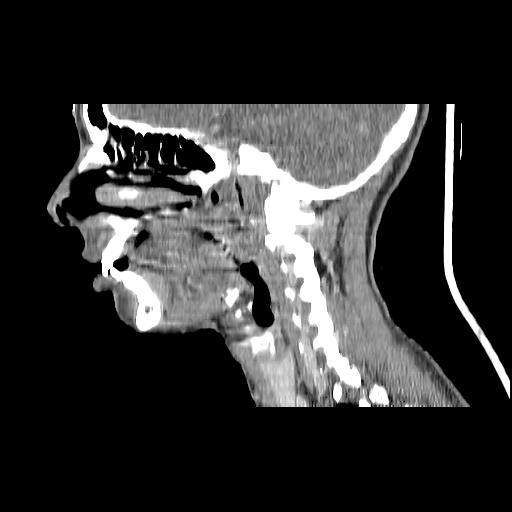 Carcinoma of the maxillary antrum (Radiopaedia 53805-59888 Sagittal C+ delayed 111).jpg