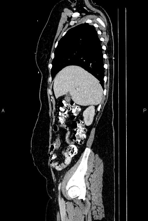 Carcinoma of uterine cervix (Radiopaedia 85861-101700 D 16).jpg