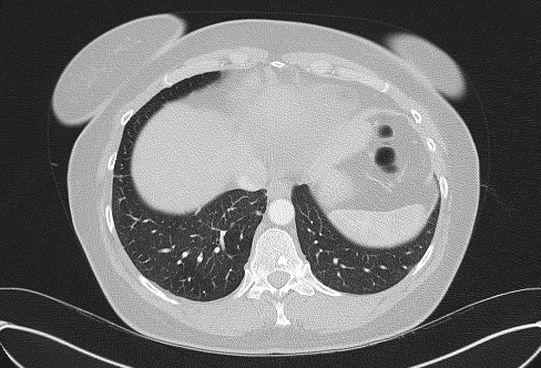 File:Cardiac sarcoidosis (Radiopaedia 74548-85534 Axial lung window 73).jpg