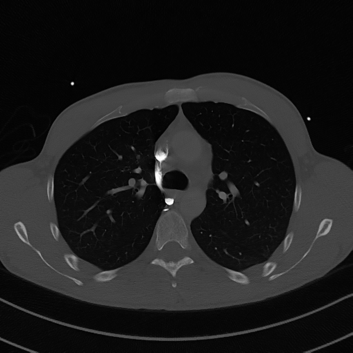 Cardiac tumor - undifferentiated pleomorphic sarcoma (Radiopaedia 45844-50134 Axial bone window 24).png