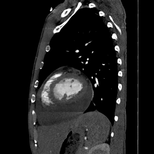 Cardiac tumor - undifferentiated pleomorphic sarcoma (Radiopaedia 45844-50134 B 20).png
