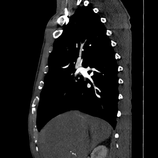 File:Cardiac tumor - undifferentiated pleomorphic sarcoma (Radiopaedia 45844-50134 B 55).png