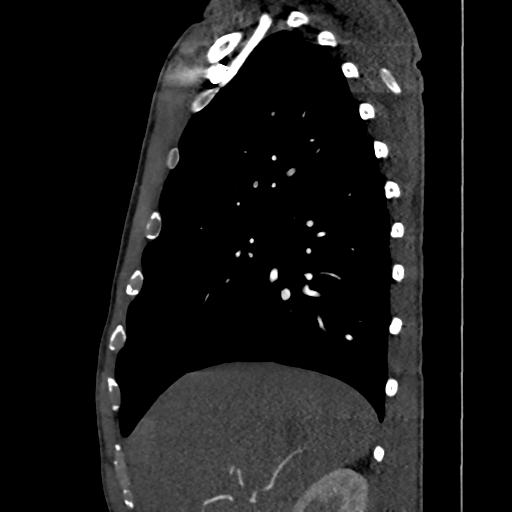 Cardiac tumor - undifferentiated pleomorphic sarcoma (Radiopaedia 45844-50134 B 60).png