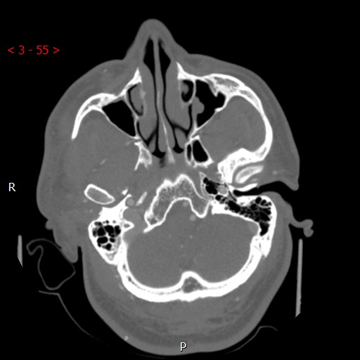 Caroticocavernous fistula (Radiopaedia 42346-45457 A 13).jpg
