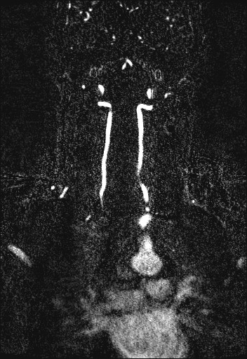 Carotid artery dissection (Radiopaedia 28441-28689 Coronal MRA 58).jpg