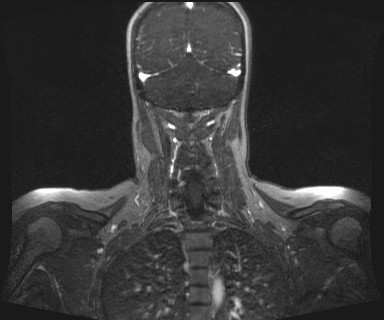 Carotid body tumor (Radiopaedia 12777-12912 MRA 59).jpg