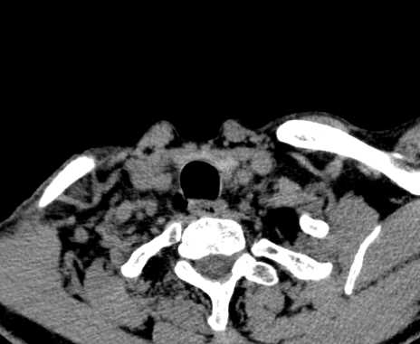 Carotid body tumor (Radiopaedia 61750-69757 Axial non-contrast 105).jpg